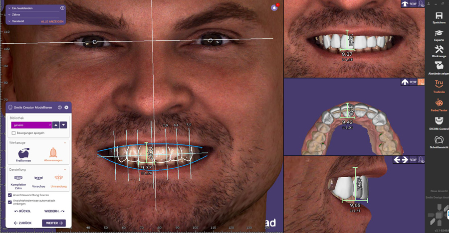 Frontal Zahnaufstellung Smile Creator